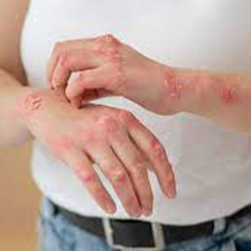 علاج الأكزيما