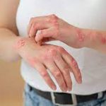 علاج الأكزيما