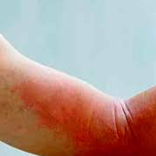 هل هناک علاج نهائي للشرى؟