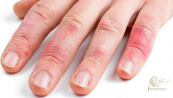 علائم آلرژی به لاتکس