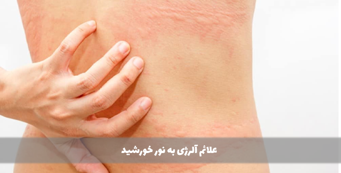 علائم آلرژی به نور خورشید