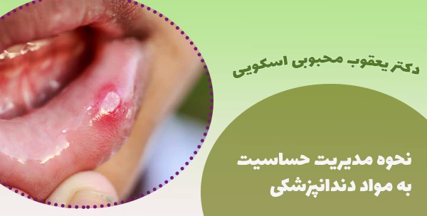 نحوه مدیریت حساسیت به مواد دندانپزشکی