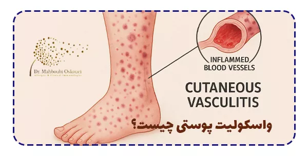 واسکولیت پوستی چیست؟